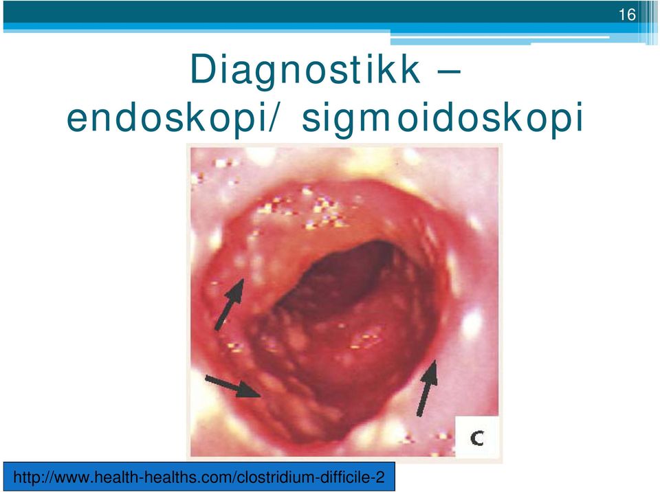 sigmoidoskopi