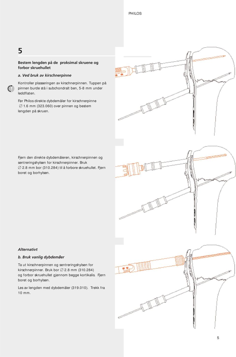 Fjern den direkte dybdemåleren, kirschnerpinnen og sentreringshylsen for kirschnerpinner. Bruk 2.8 mm bor (310.284) til å forbore skruehullet. Fjern boret og borhylsen. Alternativt b.