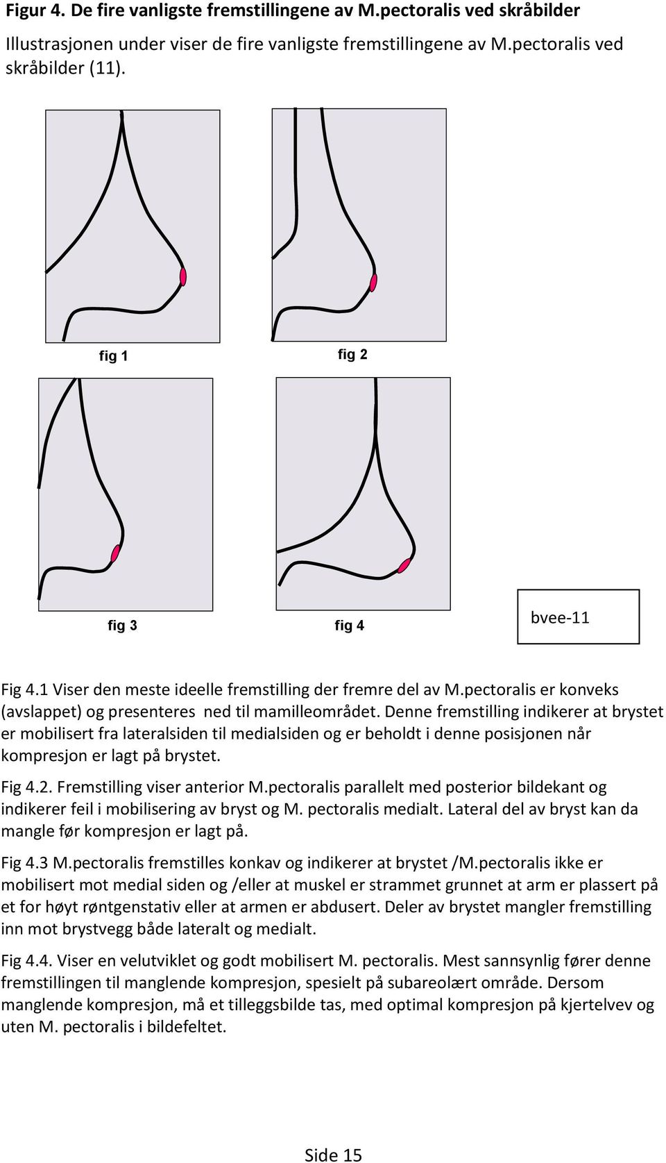 pectoralis er konveks (avslappet) og presenteres ned til mamilleområdet.