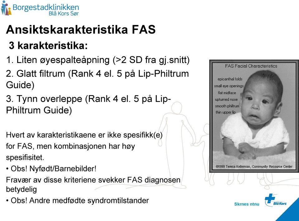 5 på Lip- Philtrum Guide) Hvert av karakteristikaene er ikke spesifikk(e) for FAS, men kombinasjonen har