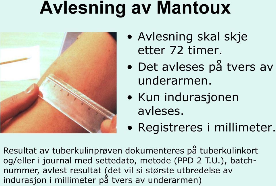 Resultat av tuberkulinprøven dokumenteres på tuberkulinkort og/eller i journal med