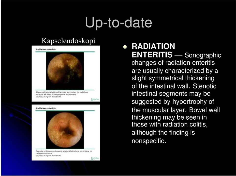 Stenotic intestinal segments may be suggested by hypertrophy of the muscular layer.