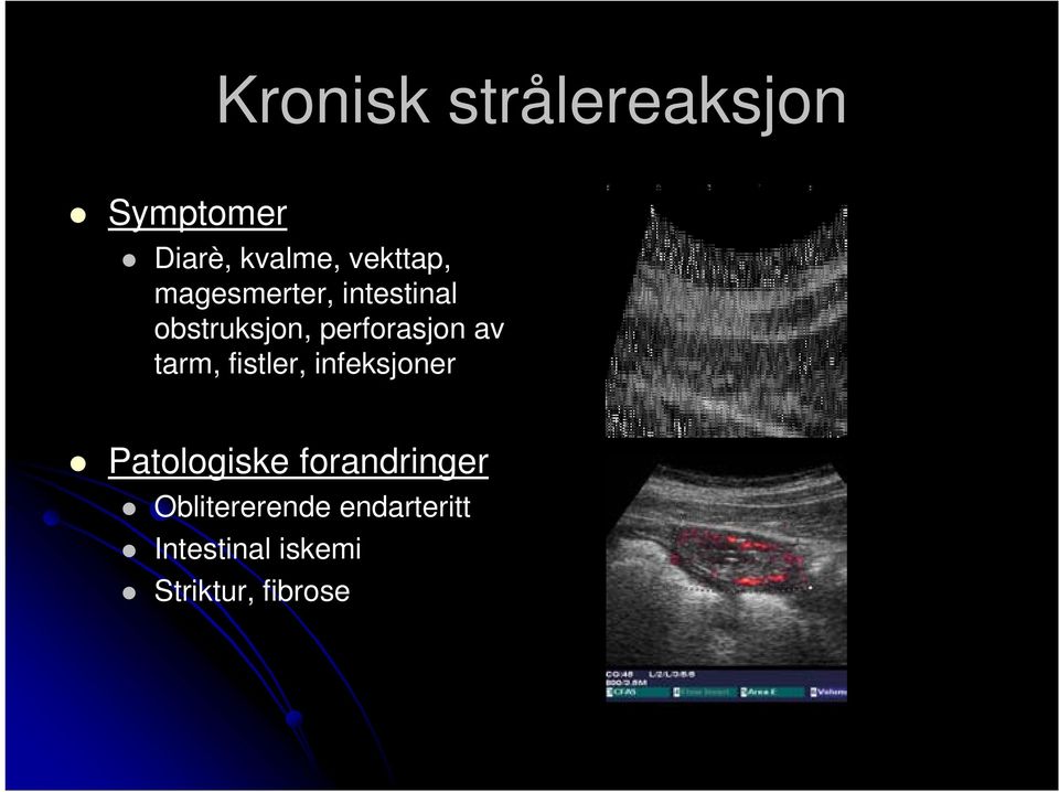 perforasjon av tarm, fistler, infeksjoner Patologiske