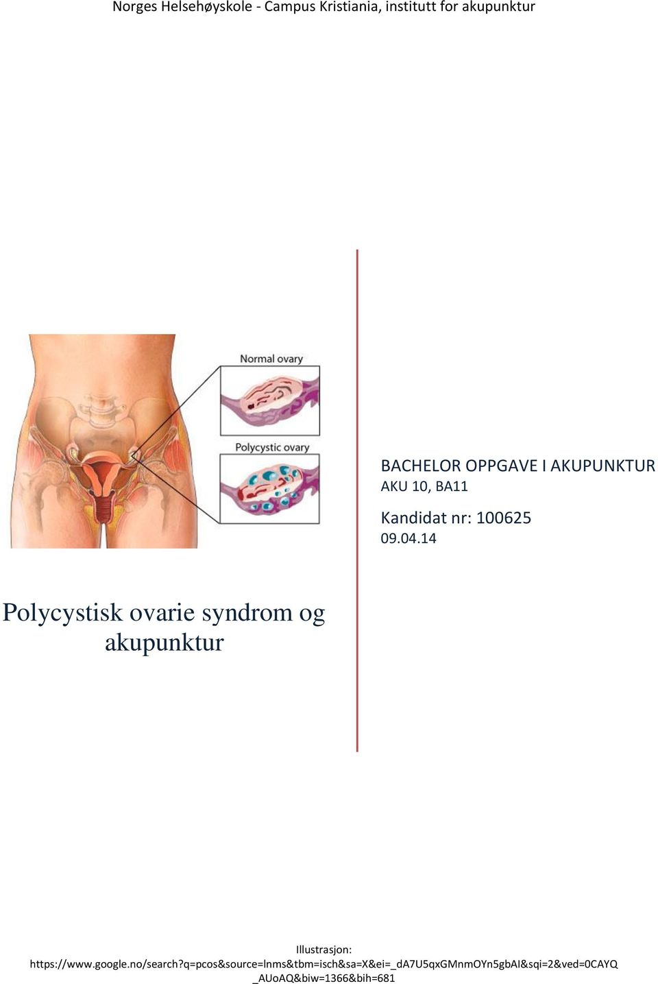 14 Polycystisk ovarie syndrom og akupunktur Illustrasjon: https://www.google.