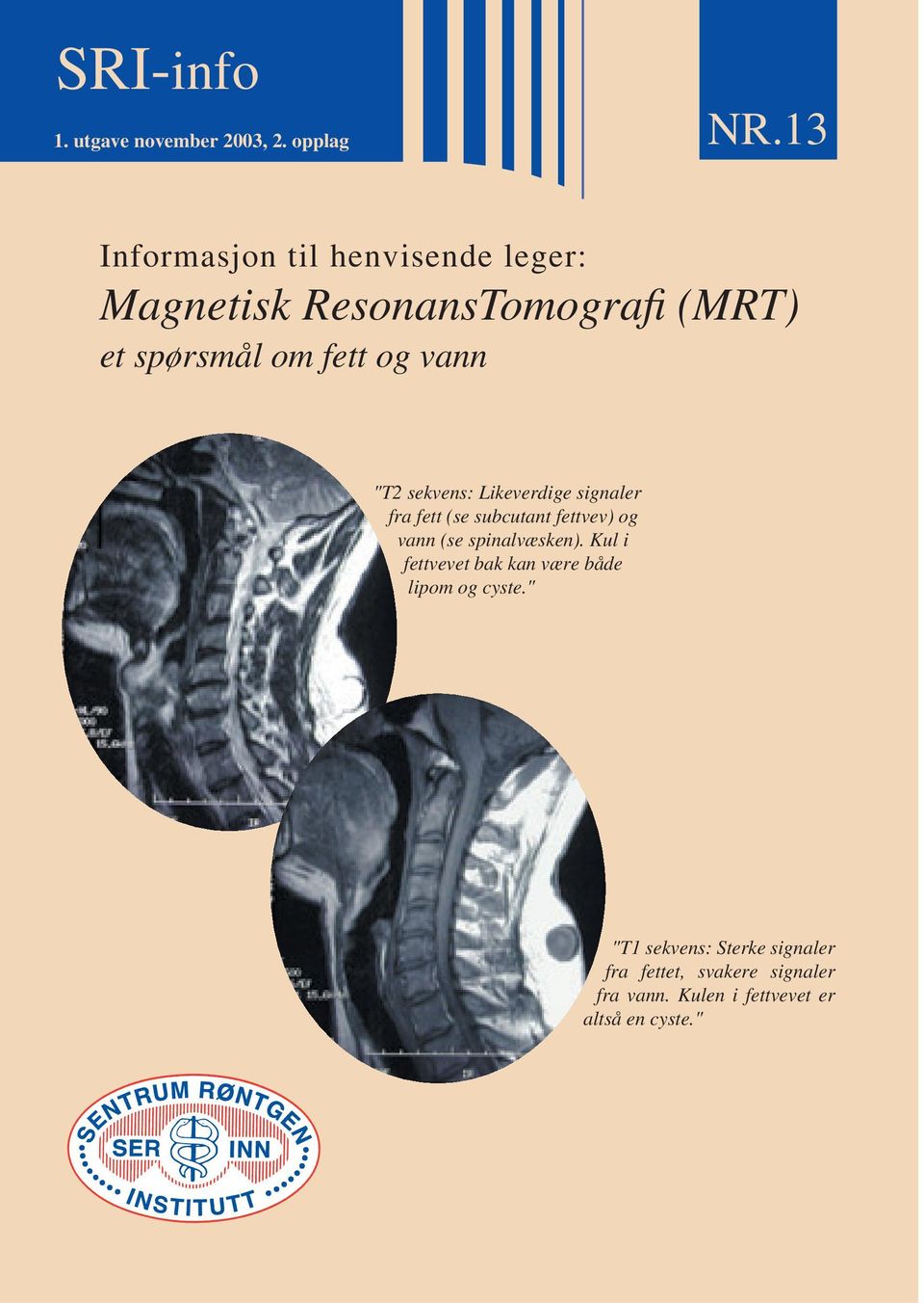 "T2 sekvens: Likeverdige signaler fra fett (se subcutant fettvev) og vann (se spinalvæsken).