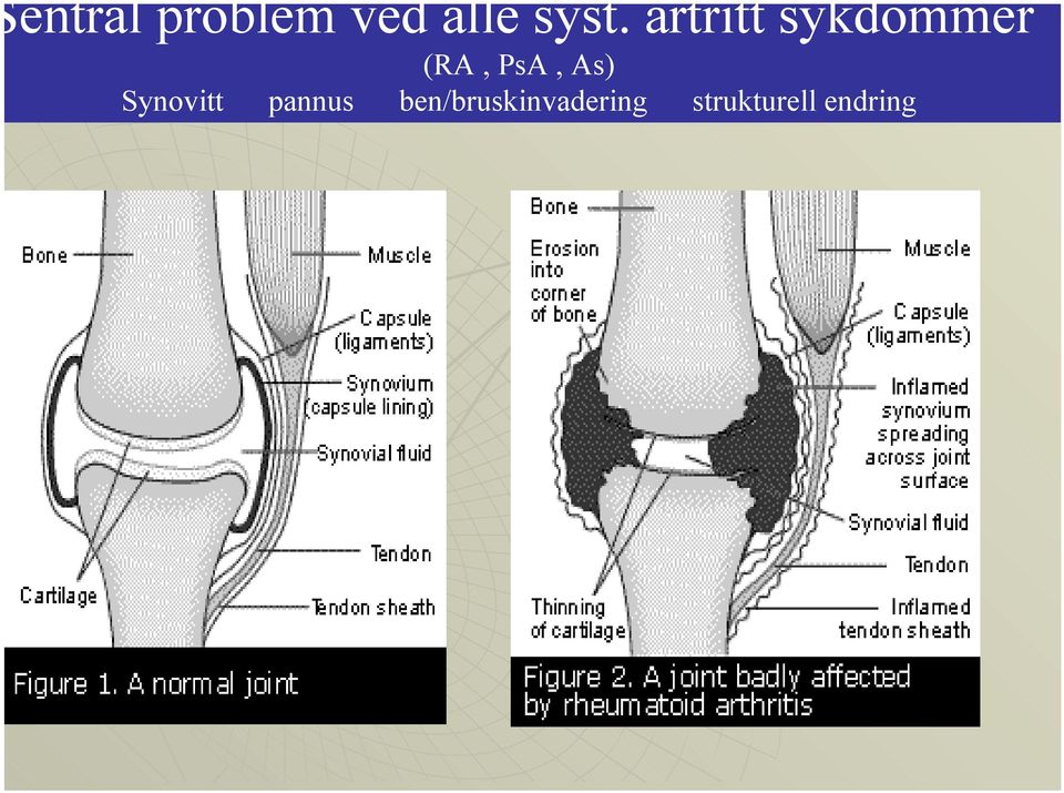 As) Synovitt pannus