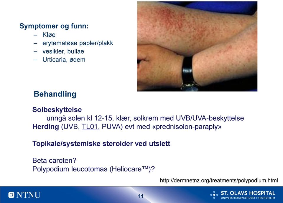 Herding (UVB, TL01, PUVA) evt med «prednisolon-paraply» Topikale/systemiske steroider ved