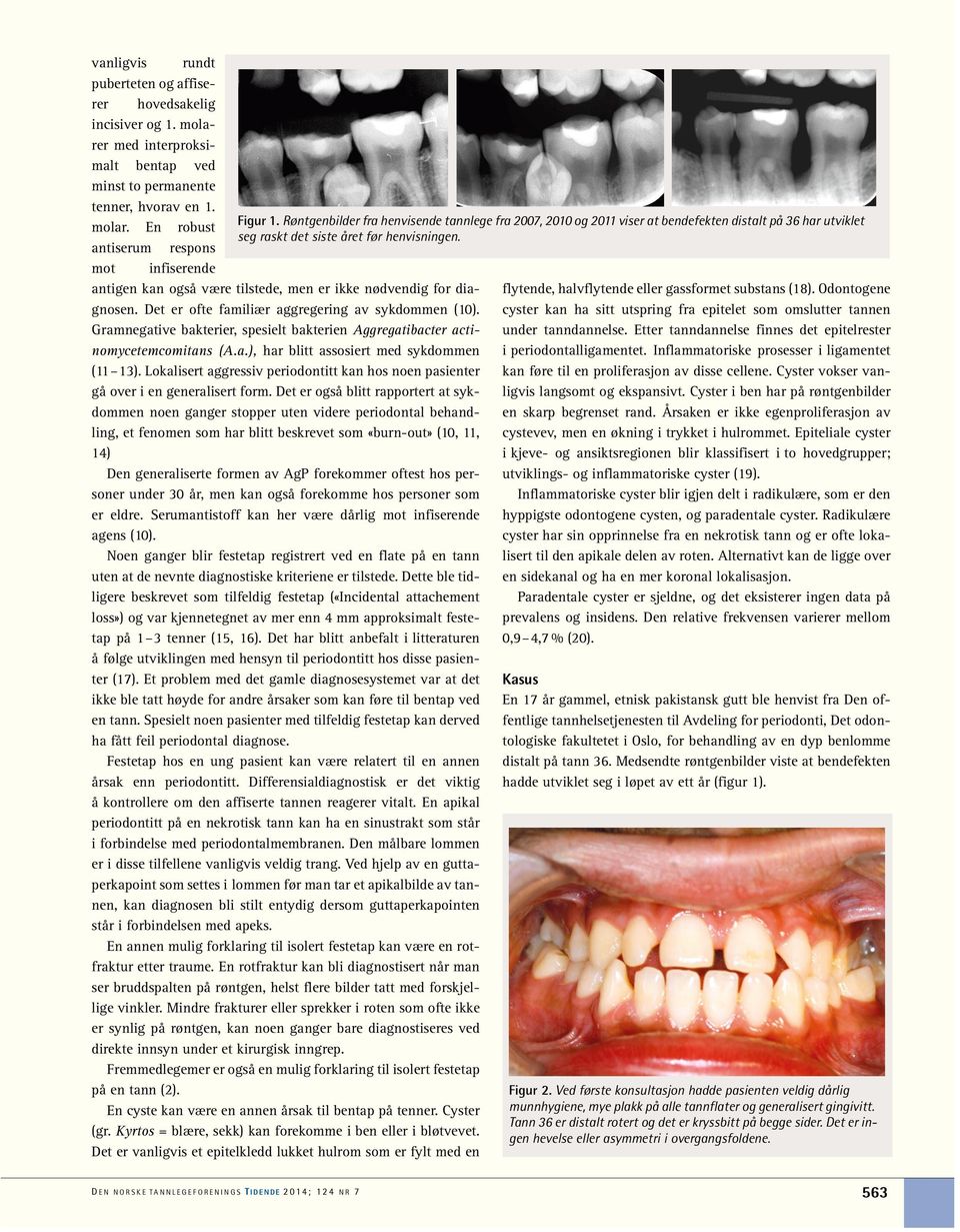 Røntgenbilder fra henvisende tannlege fra 2007, 2010 og 2011 viser at bendefekten distalt på 36 har utviklet molar. En robust seg raskt det siste året før henvisningen.