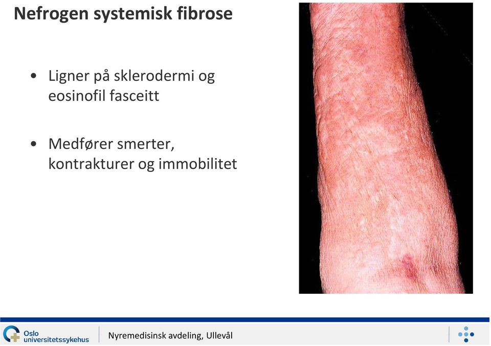 eosinofil fasceitt Medfører