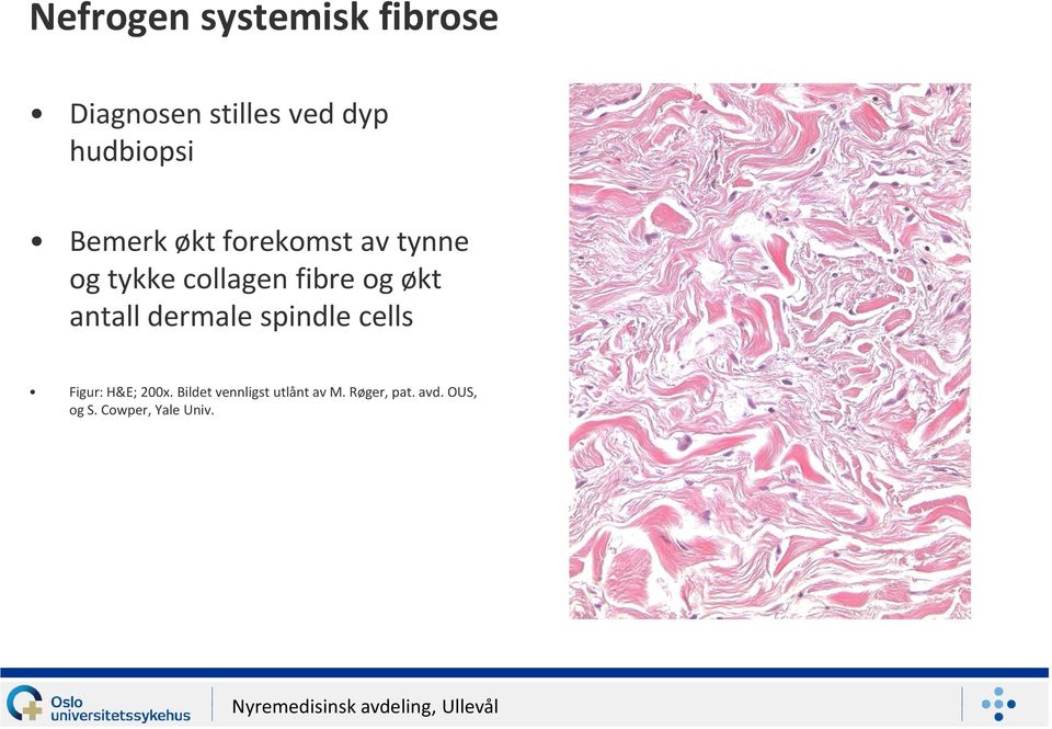 fibre og økt antall dermale spindle cells Figur: H&E; 200x.