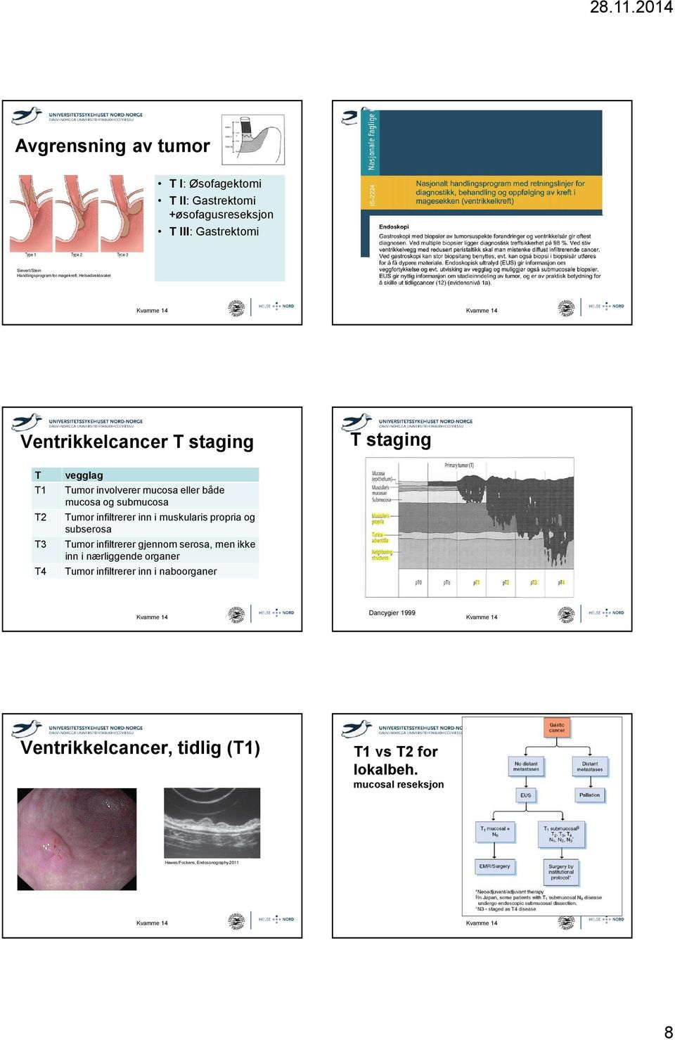 submucosa T2 Tumor infiltrerer inn i muskularispropria og subserosa T3 Tumor infiltrerergjennom serosa, men ikke inn i