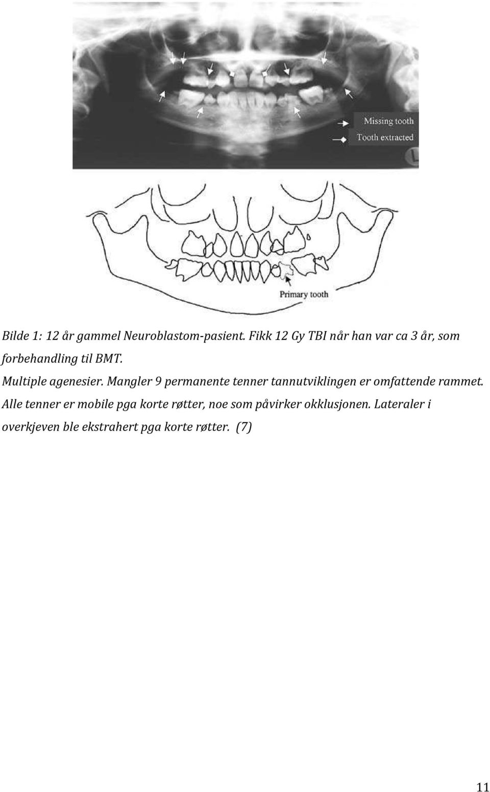 Mangler 9 permanente tenner tannutviklingen er omfattende rammet.