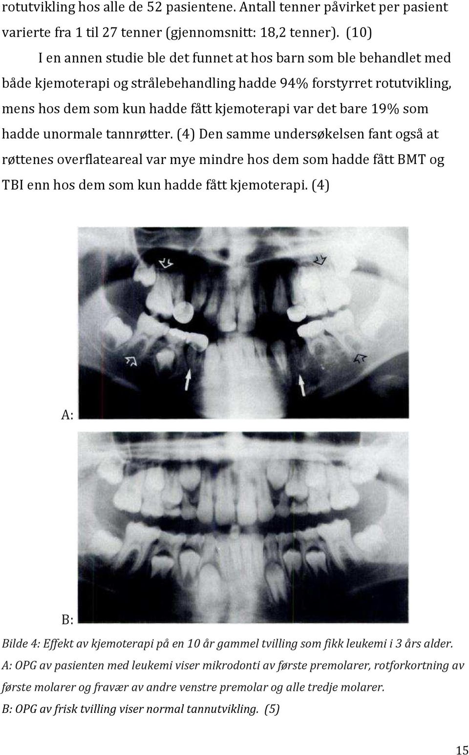bare 19% som hadde unormale tannrøtter. (4) Den samme undersøkelsen fant også at røttenes overflateareal var mye mindre hos dem som hadde fått BMT og TBI enn hos dem som kun hadde fått kjemoterapi.