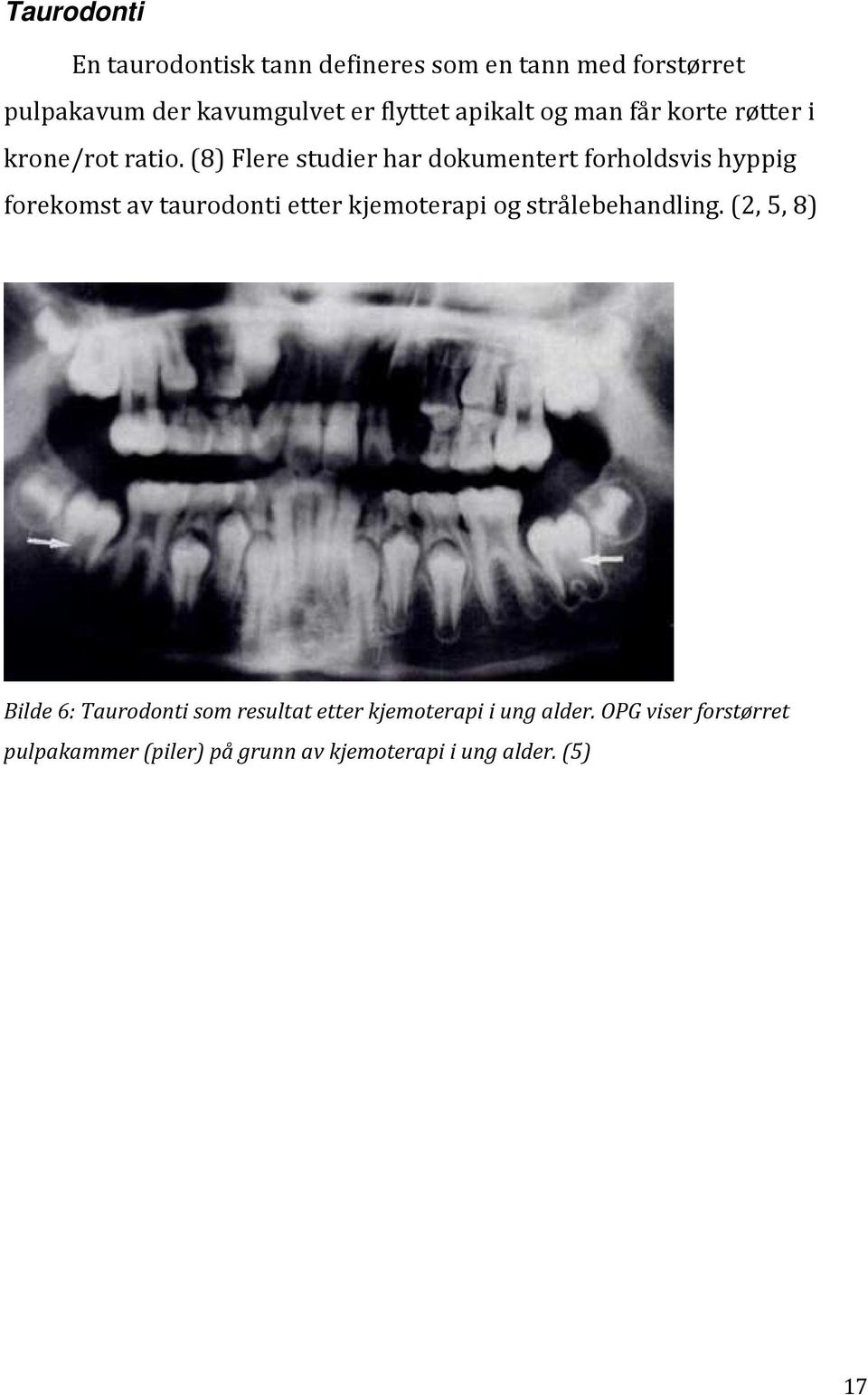 (8) Flere studier har dokumentert forholdsvis hyppig forekomst av taurodonti etter kjemoterapi og