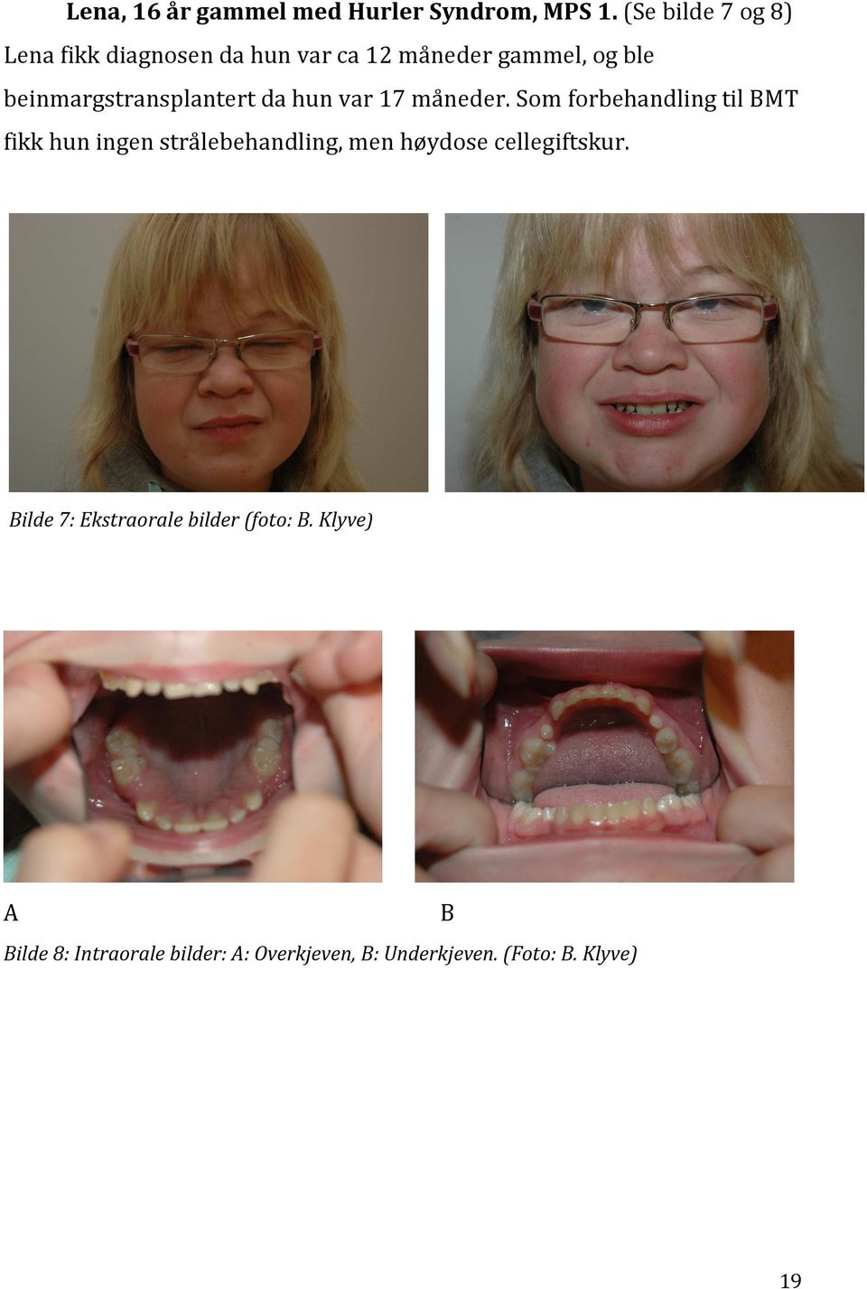 beinmargstransplantert da hun var 17 måneder.