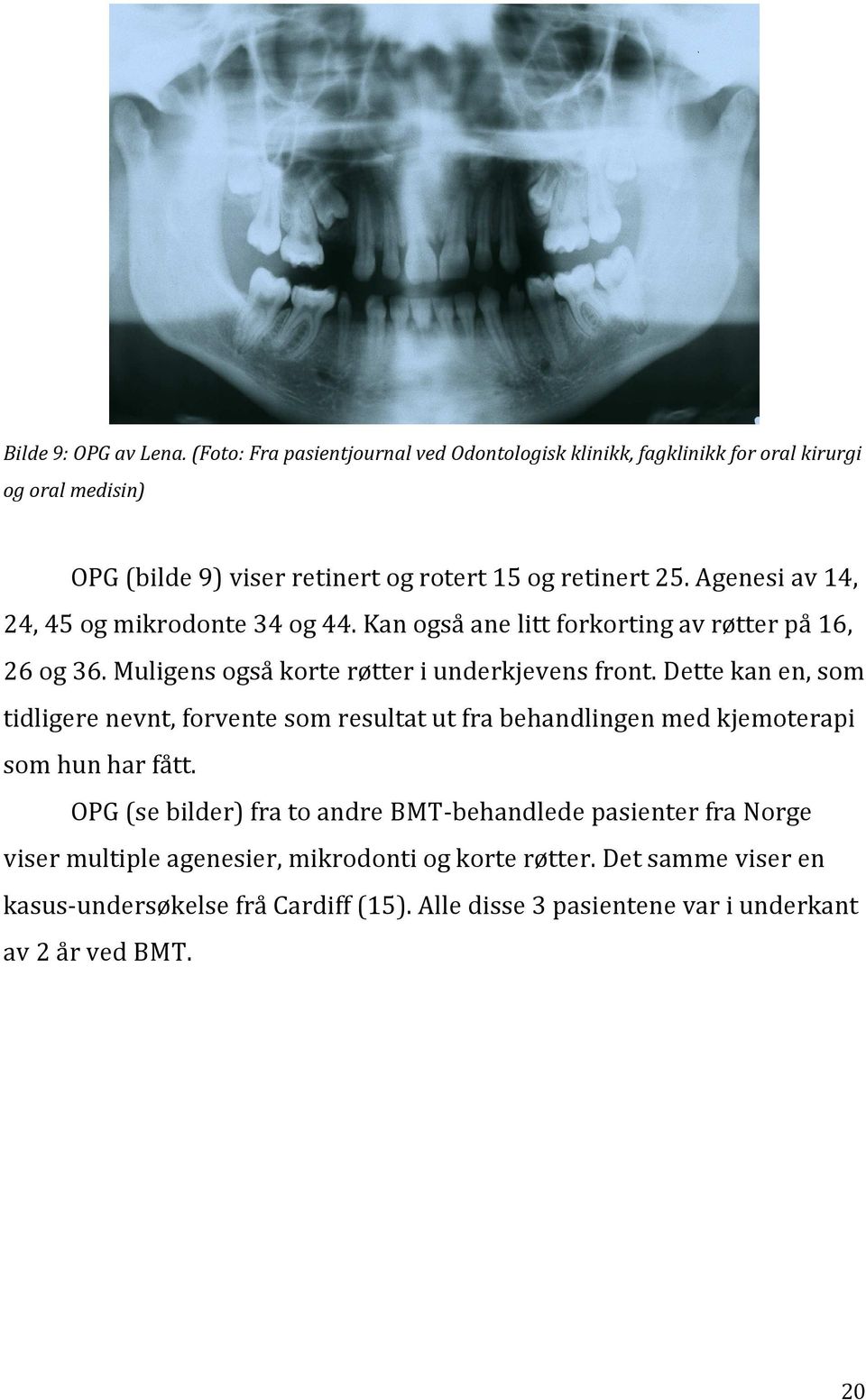 Agenesi av 14, 24, 45 og mikrodonte 34 og 44. Kan også ane litt forkorting av røtter på 16, 26 og 36. Muligens også korte røtter i underkjevens front.