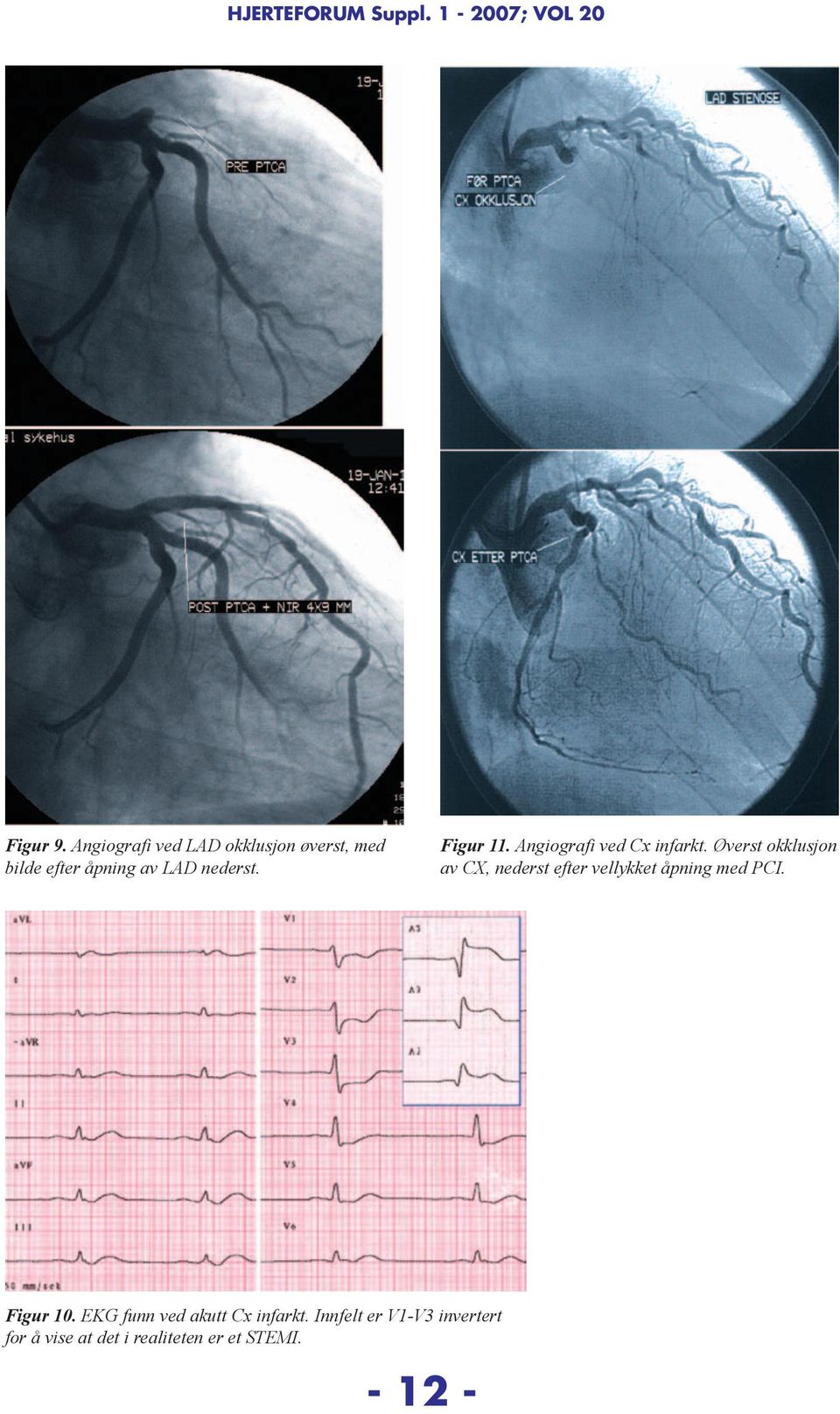 Angiografi ved Cx infarkt.