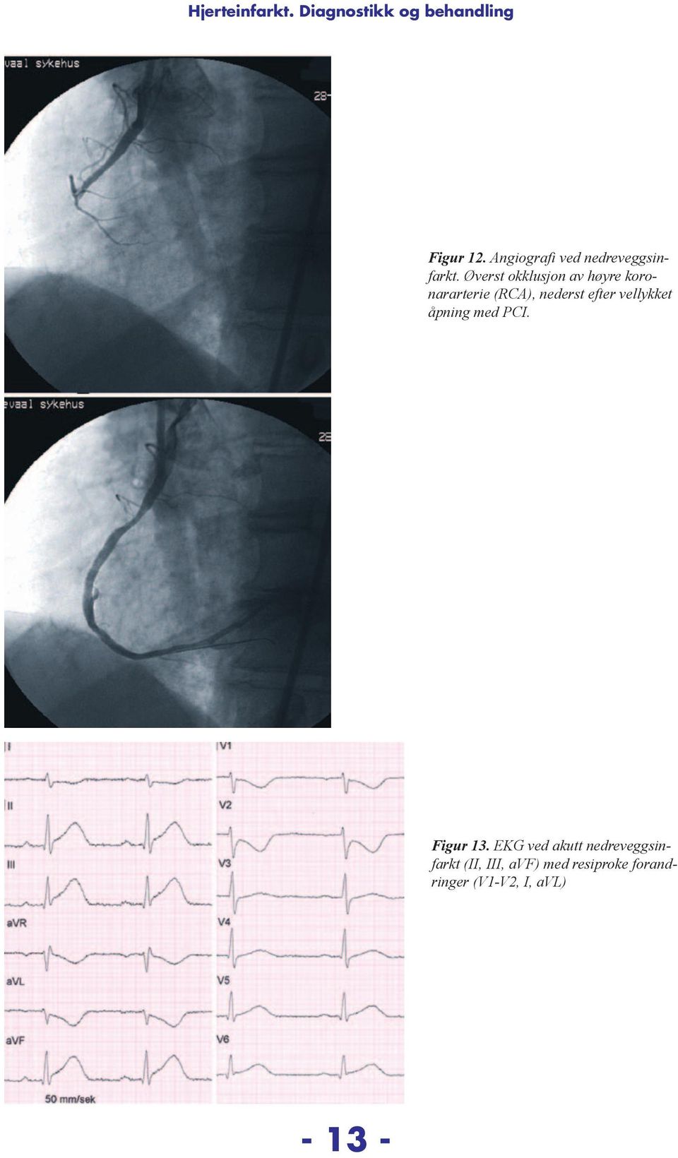 efter vellykket åpning med PCI. Figur 13.