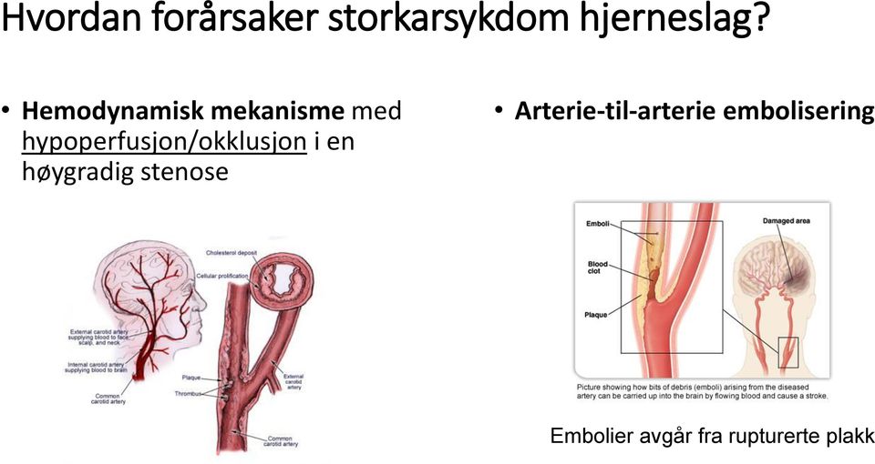 hypoperfusjon/okklusjon i en høygradig stenose