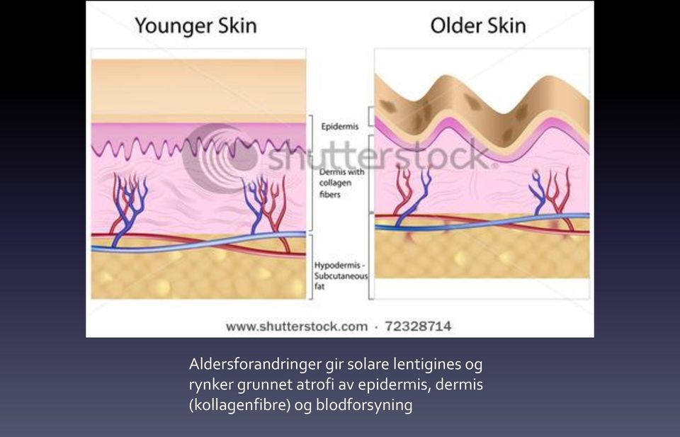 atrofi av epidermis, dermis