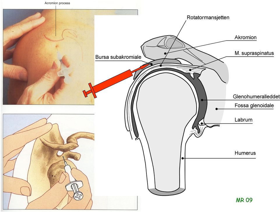 supraspinatus