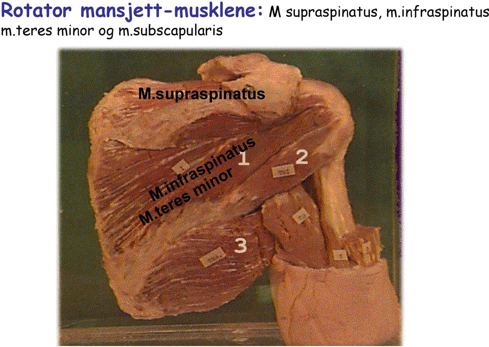 infraspinatus m.