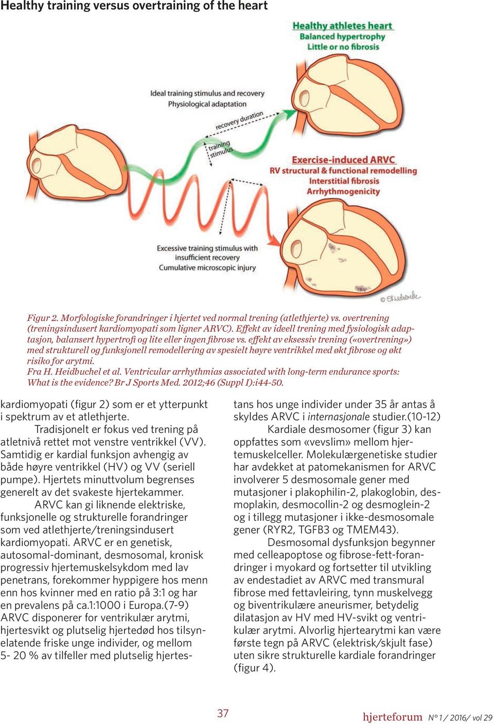 effekt av eksessiv trening («overtrening») med strukturell og funksjonell remodellering av spesielt høyre ventrikkel med økt fibrose og økt risiko for arytmi. Fra H. Heidbuchel et al.