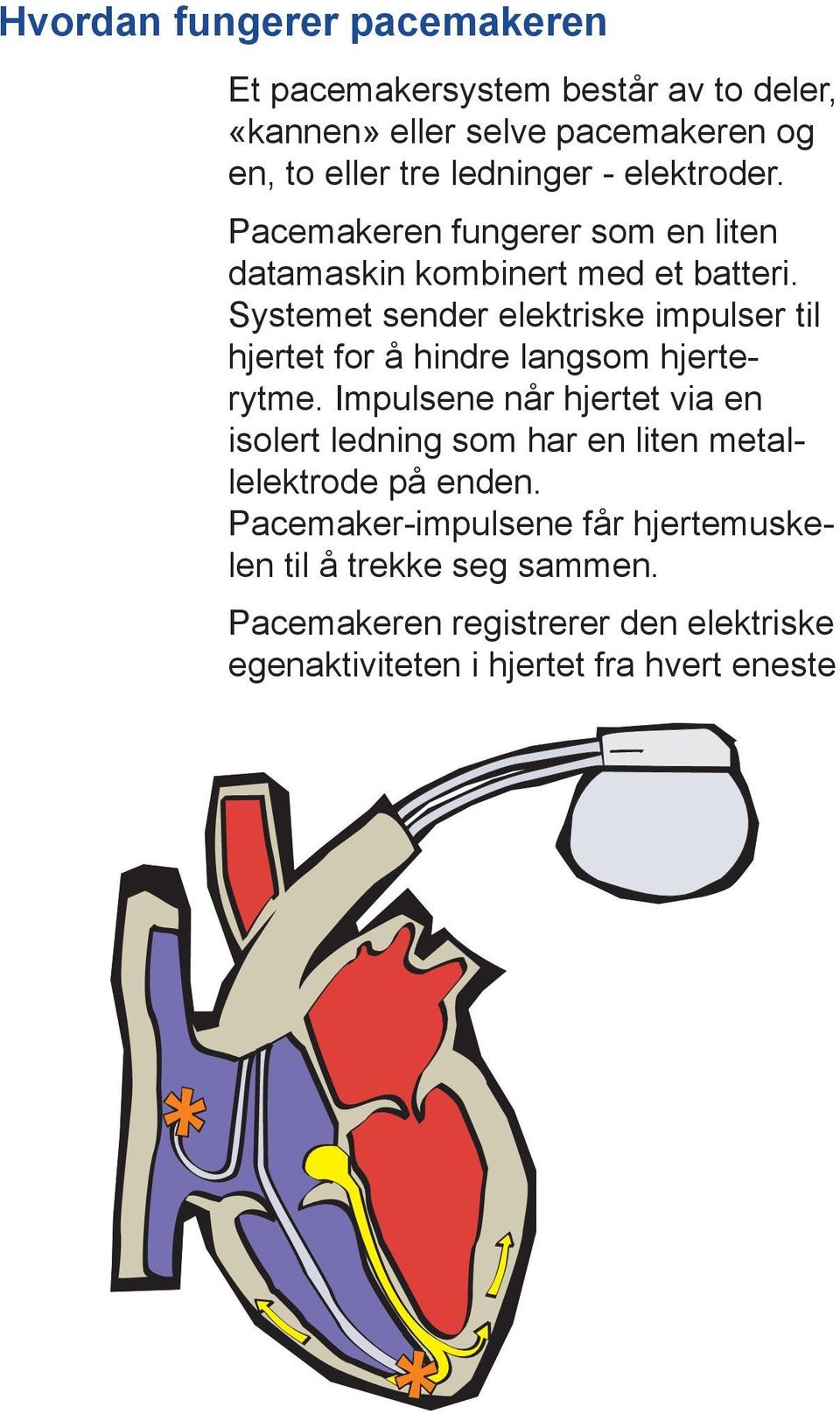 Systemet sender elektriske impulser til hjertet for å hindre langsom hjerterytme.