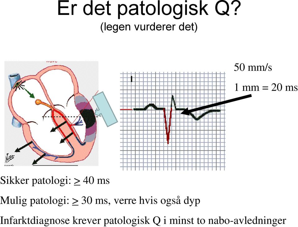 patologi: > 40 ms Mulig patologi: > 30 ms, verre