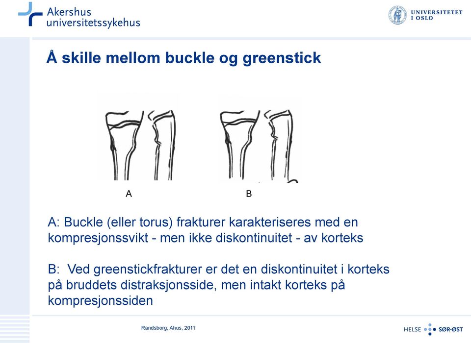 korteks B: Ved greenstickfrakturer er det en diskontinuitet i korteks på