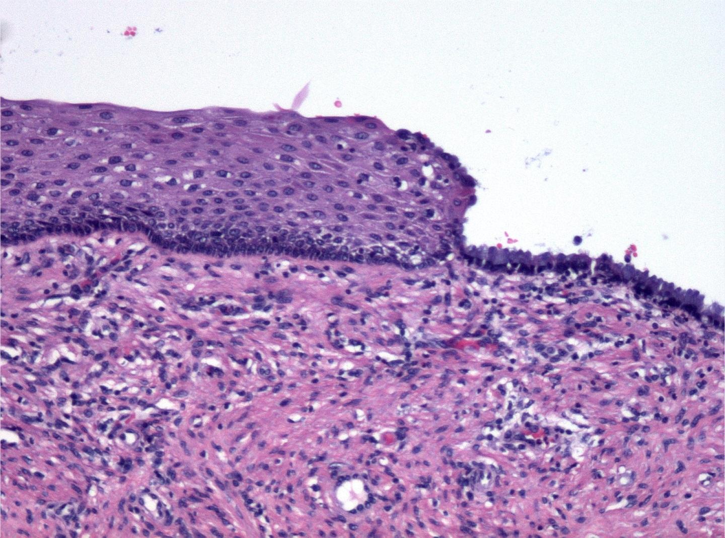 HPV - DNA virus Artspesifikk, infiserer plateepitel i hud