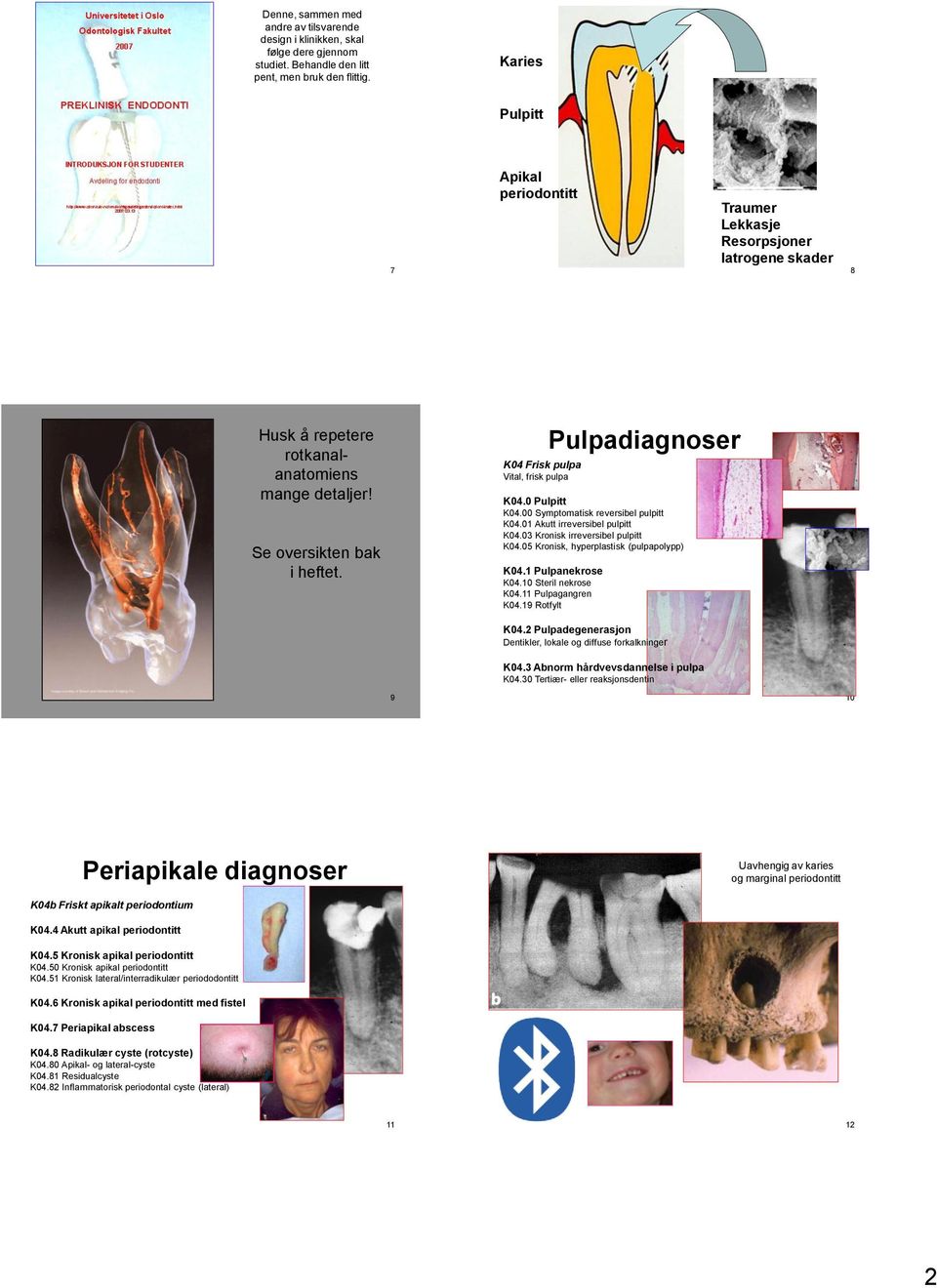 K04 Frisk pulpa Vital, frisk pulpa Pulpadiagnoser K04.0 Pulpitt K04.00 Symptomatisk reversibel pulpitt K04.01 Akutt irreversibel pulpitt K04.03 Kronisk irreversibel pulpitt K04.