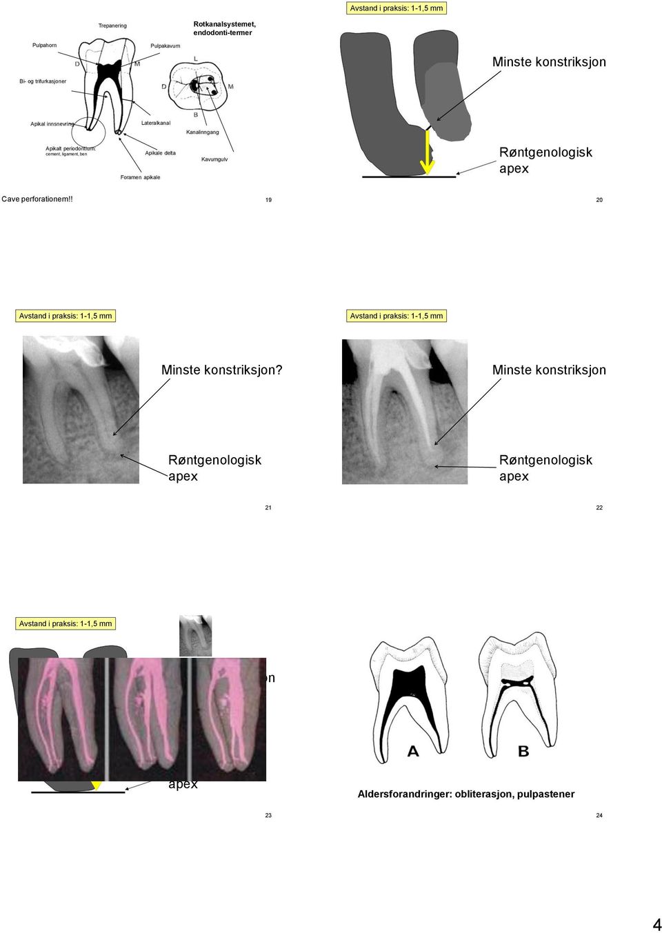 Cave perforationem!! 19 20 Avstand i praksis: 1-1,5 mm Avstand i praksis: 1-1,5 mm Minste konstriksjon?