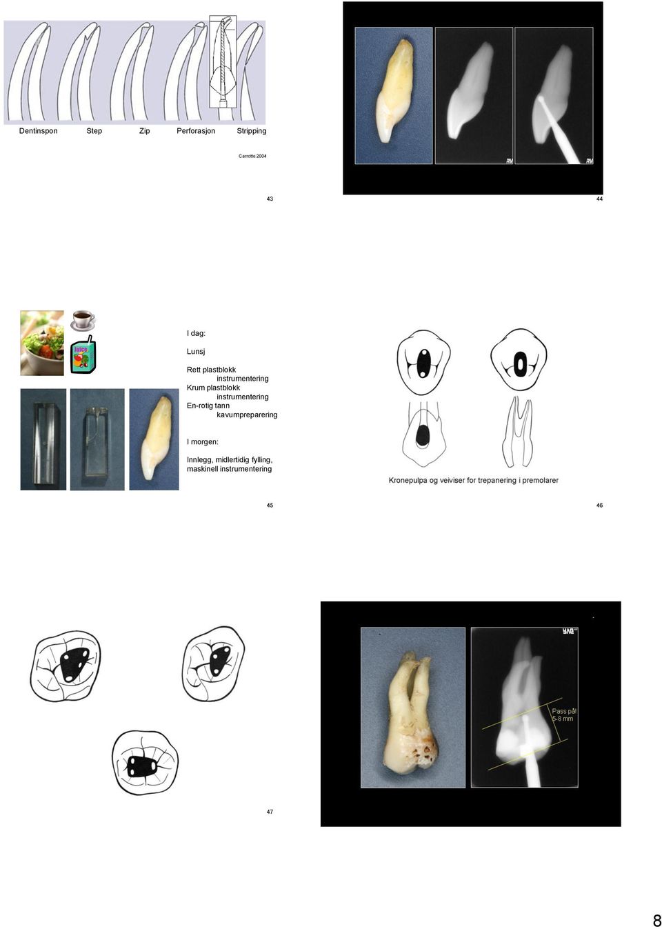 instrumentering En-rotig tann kavumpreparering I morgen: