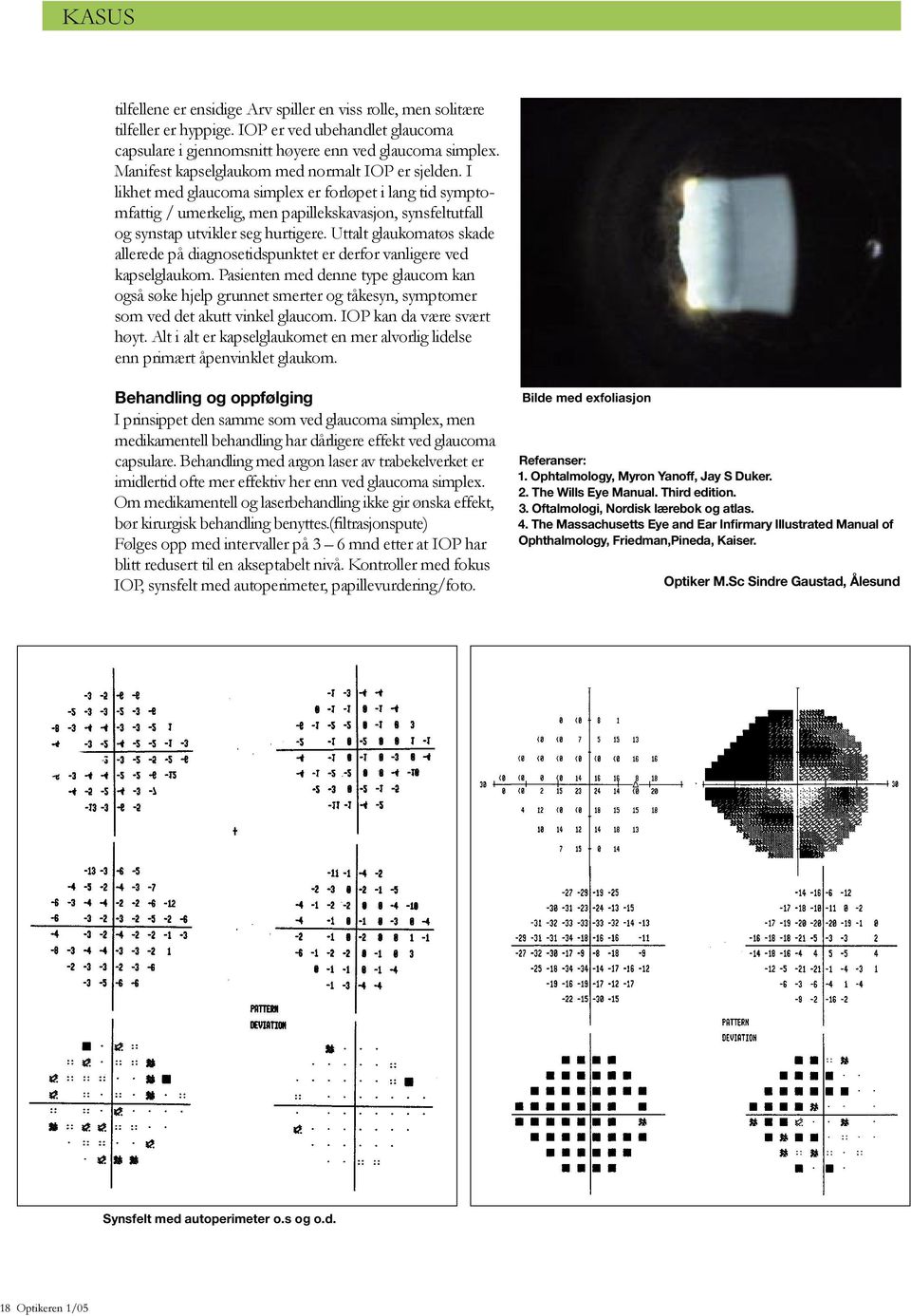 I likhet med glaucoma simplex er forløpet i lang tid symptomfattig / umerkelig, men papillekskavasjon, synsfeltutfall og synstap utvikler seg hurtigere.