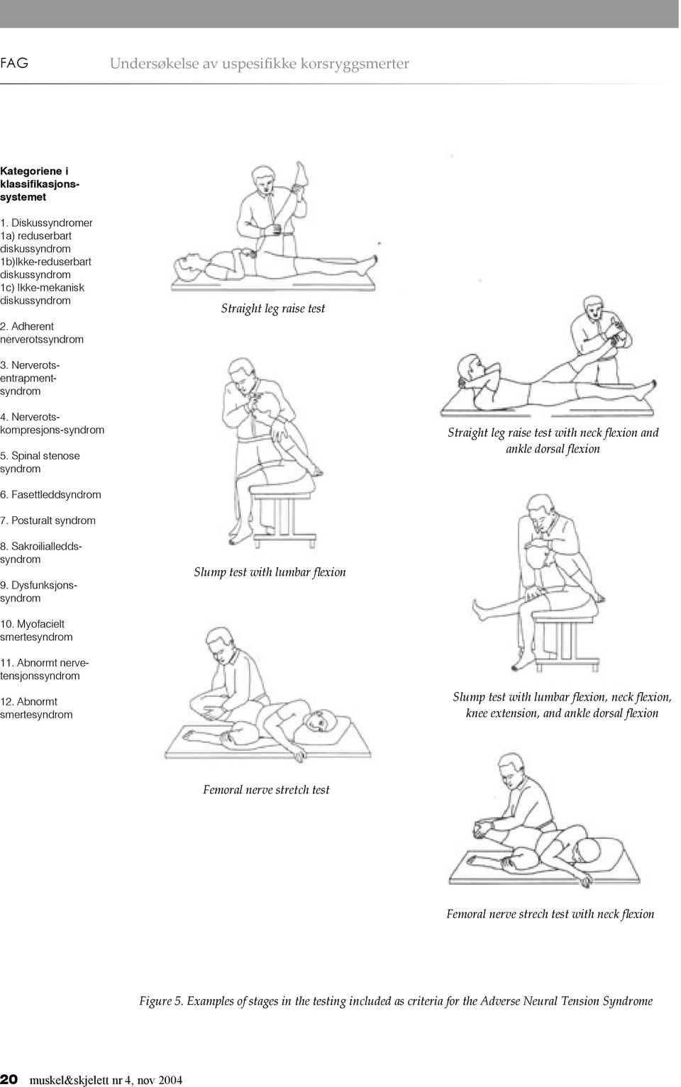 Nerverotskompresjons-syndrom 5. Spinal stenose syndrom 6. Fasettleddsyndrom 7. Posturalt syndrom 8. Sakroilialleddssyndrom 9. Dysfunksjonssyndrom 10. Myofacielt smertesyndrom 11.