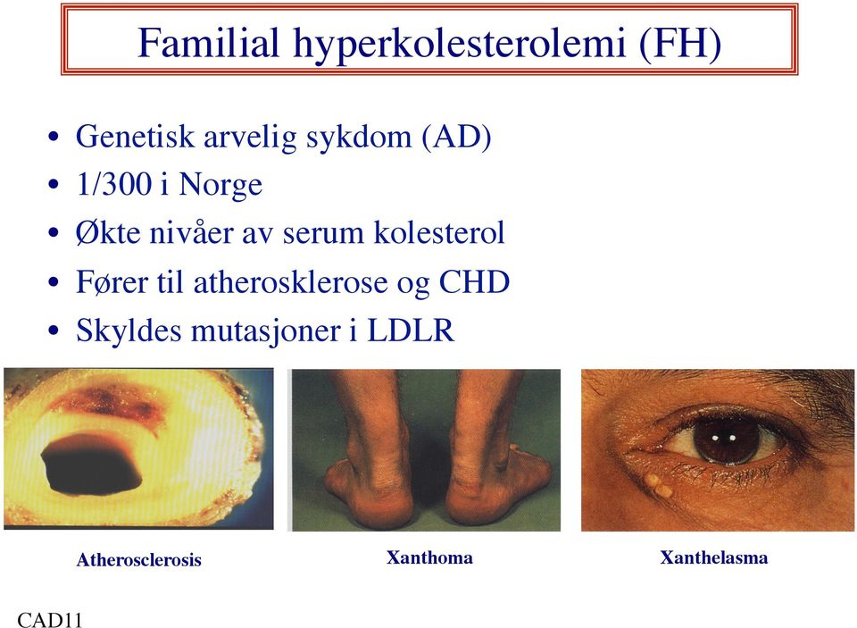 kolesterol Fører til atherosklerose og CHD Skyldes