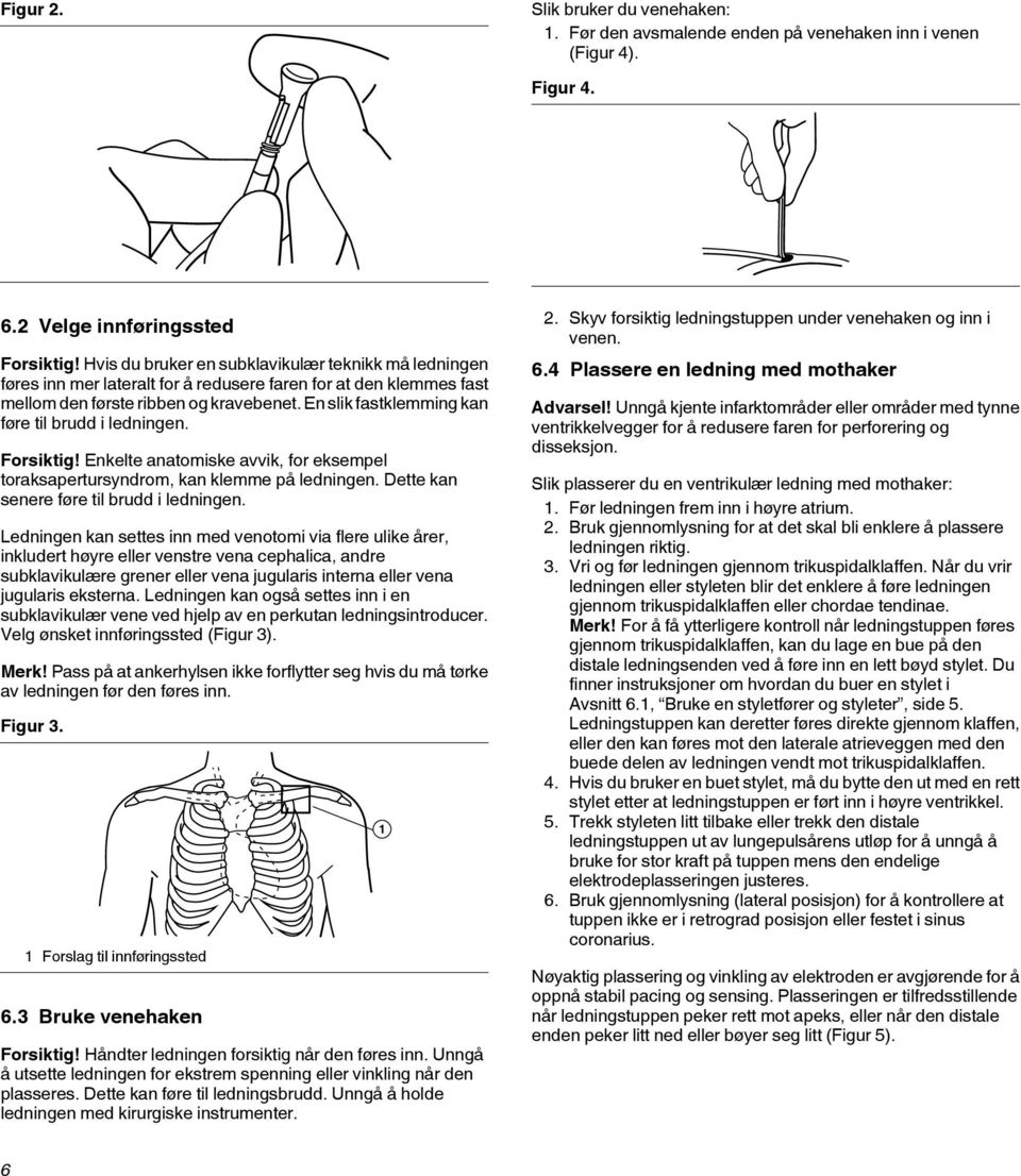 En slik fastklemming kan føre til brudd i ledningen. Forsiktig! Enkelte anatomiske avvik, for eksempel toraksapertursyndrom, kan klemme på ledningen. Dette kan senere føre til brudd i ledningen.