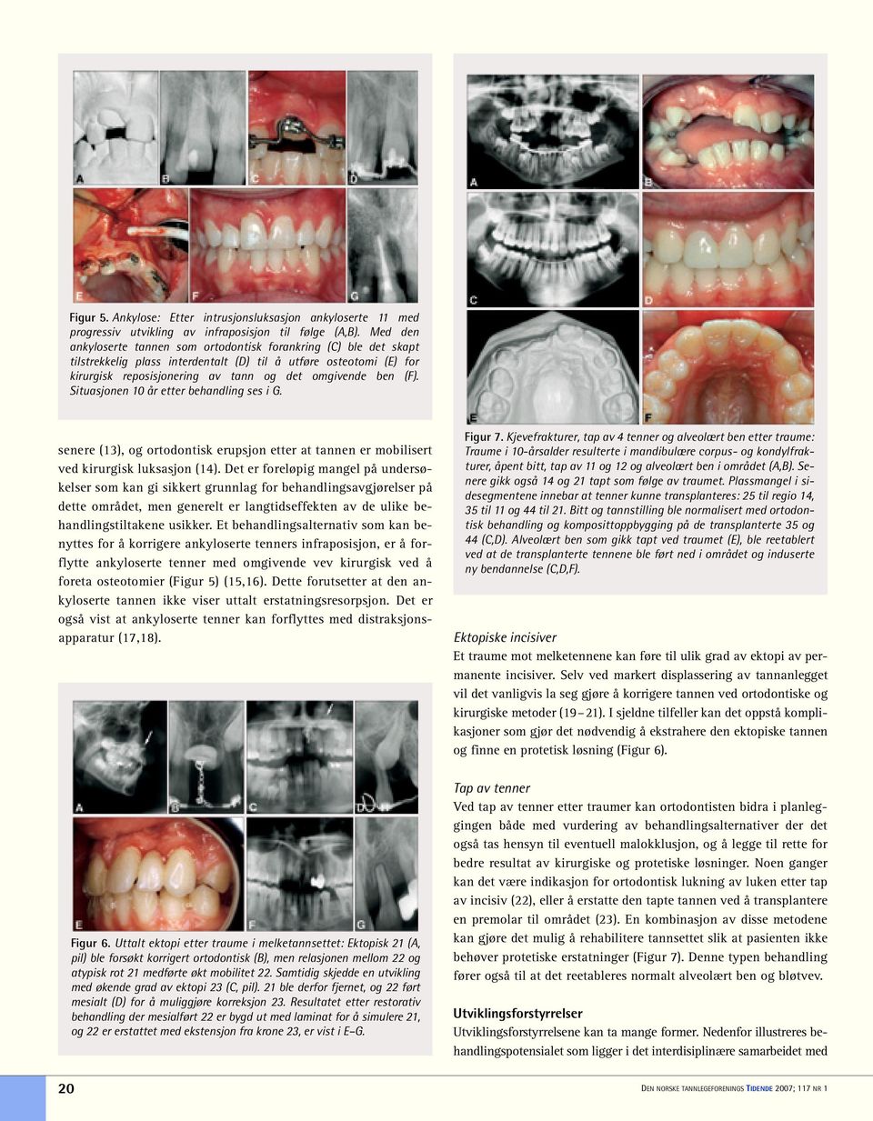 Situasjonen 10 år etter behandling ses i G. senere (13), og ortodontisk erupsjon etter at tannen er mobilisert ved kirurgisk luksasjon (14).