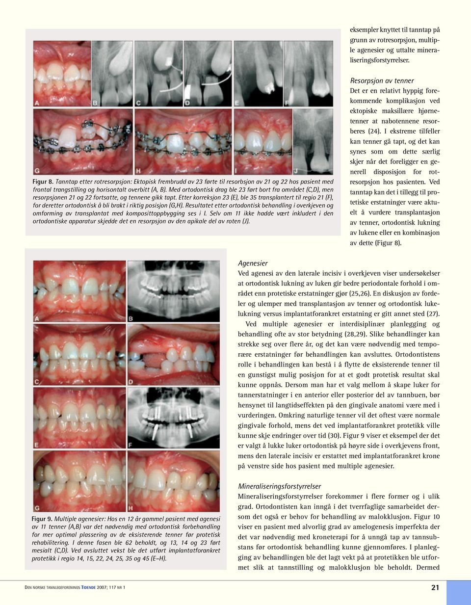 Med ortodontisk drag ble 23 ført bort fra området (C,D), men resorpsjonen 21 og 22 fortsatte, og tennene gikk tapt.