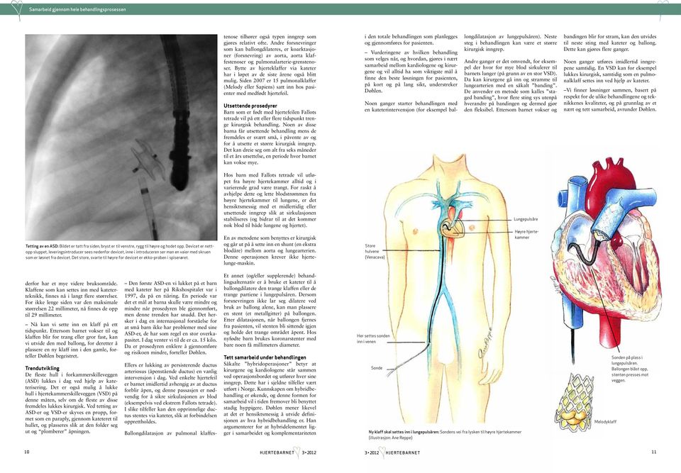 Bytte av hjerteklaffer via kateter har i løpet av de siste årene også blitt mulig. Siden 2007 er 15 pulmonalklaffer (Melody eller Sapiens) satt inn hos pasienter med medfødt hjertefeil.