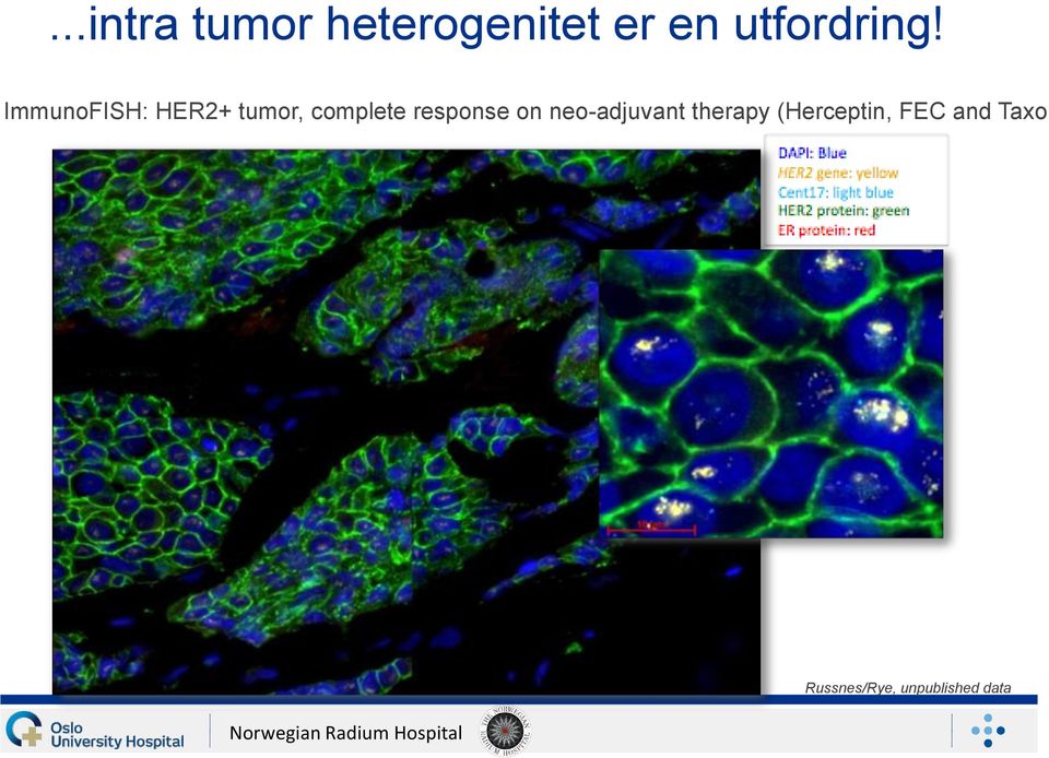 neo-adjuvant therapy (Herceptin, FEC and Taxol