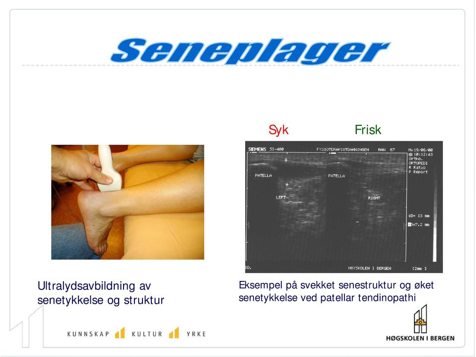 på svekket senestruktur og øket