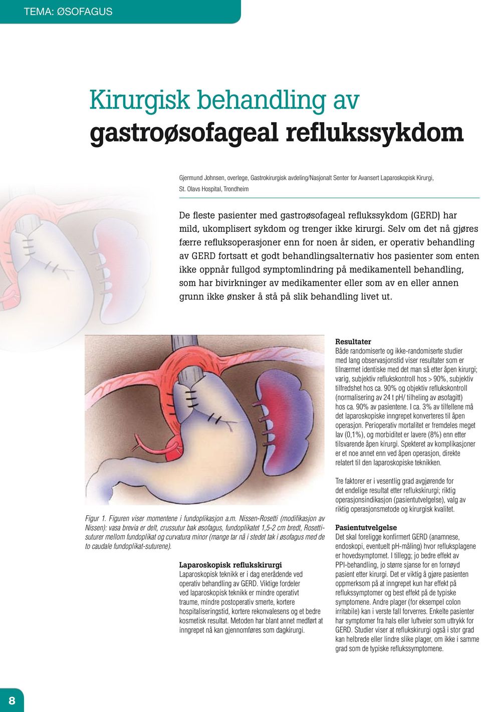 Selv om det nå gjøres færre refluksoperasjoner enn for noen år siden, er operativ behandling av GERD fortsatt et godt behandlingsalternativ hos pasienter som enten ikke oppnår fullgod symptomlindring