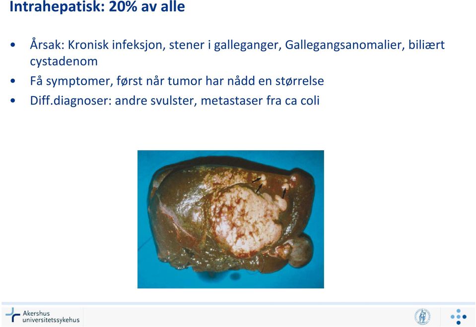 cystadenom Få symptomer, først når tumor har nådd en