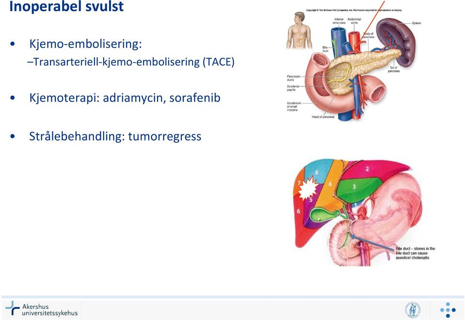 Transarteriell-kjemo-embolisering