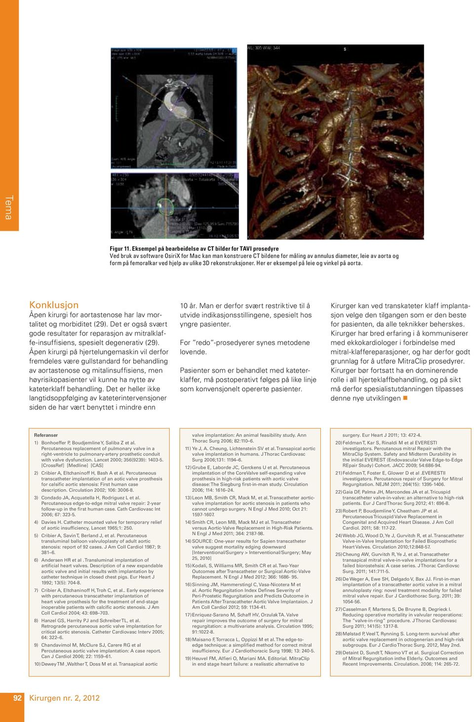 hjelp av ulike 3D rekonstruksjoner. Her er eksempel på leie og vinkel på aorta. Konklusjon Åpen kirurgi for aortastenose har lav mortalitet og morbiditet (29).