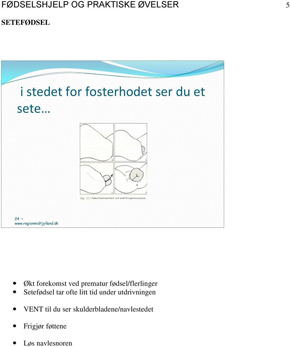 dk Økt forekomst ved prematur fødsel/flerlinger Setefødsel tar ofte