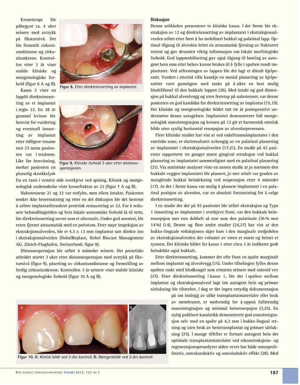 Kasus 2 viser en lappfri direkteinnsetting av et implantat i regio 22.
