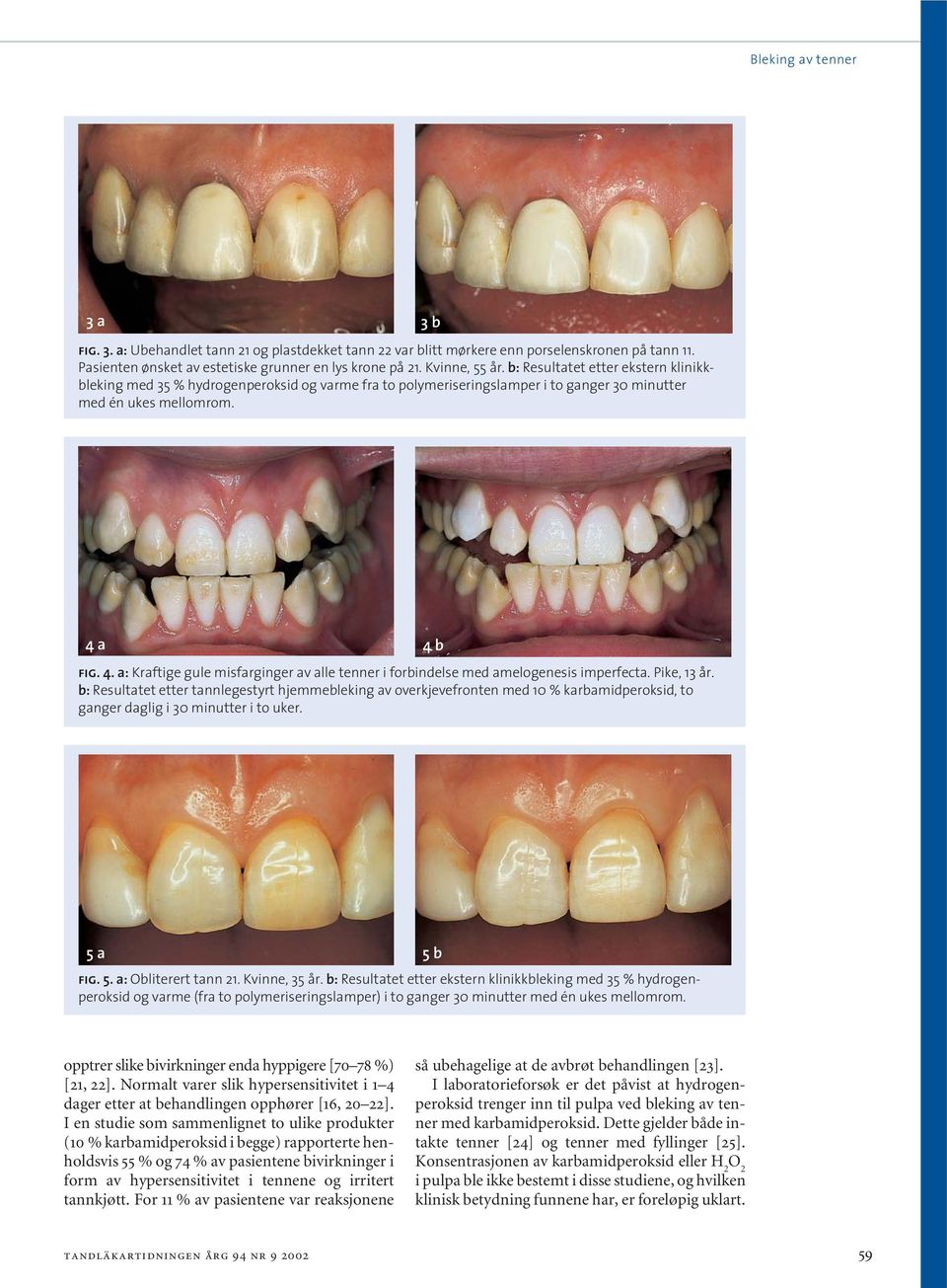 a 4 b fig. 4. a: Kraftige gule misfarginger av alle tenner i forbindelse med amelogenesis imperfecta. Pike, 13 år.